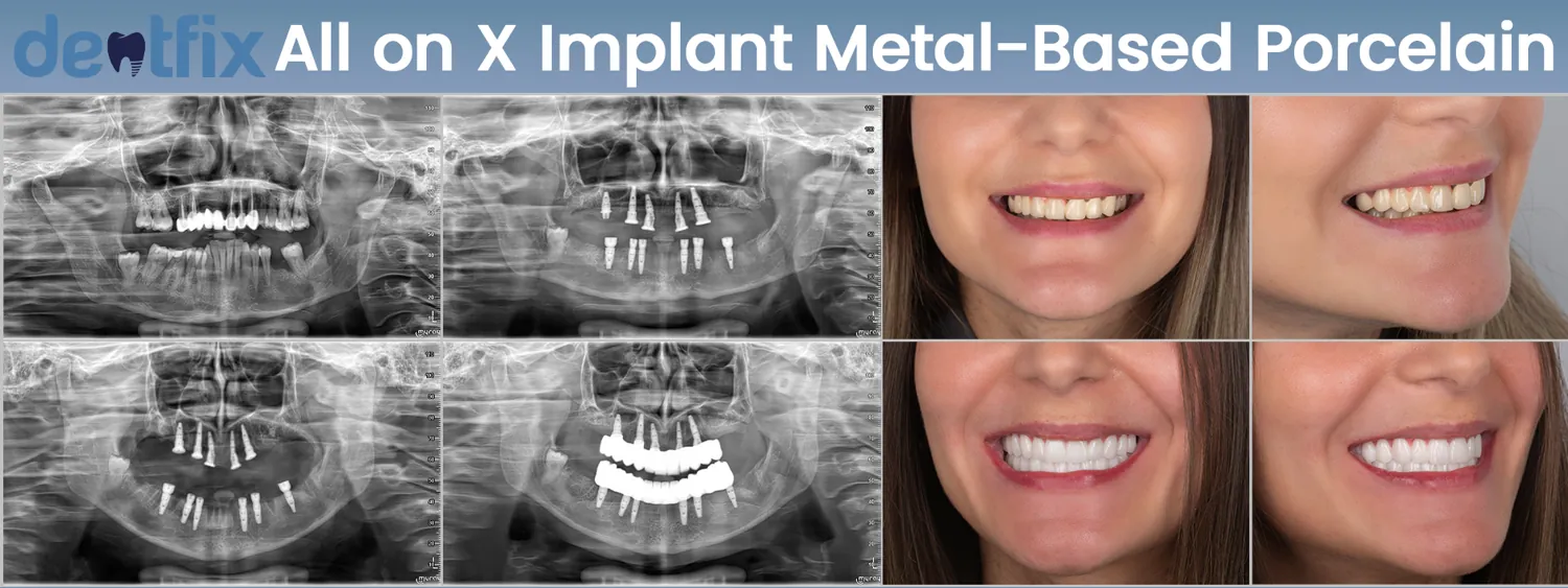 Implants de bouche complète All-on-4 / All-on-6 avant et après — radiographie et sourire, Dentfix Istanbul