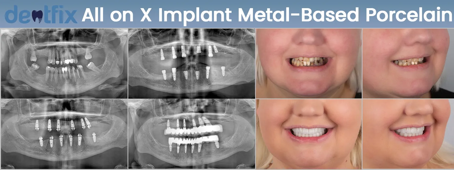 Implants de bouche complète All-on-4 / All-on-6 avant et après — radiographie et sourire, Dentfix Istanbul