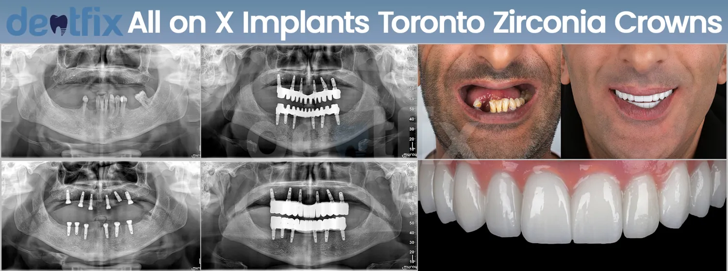 Implants de bouche complète All-on-4 / All-on-6 avant et après — radiographie et sourire, Dentfix Istanbul