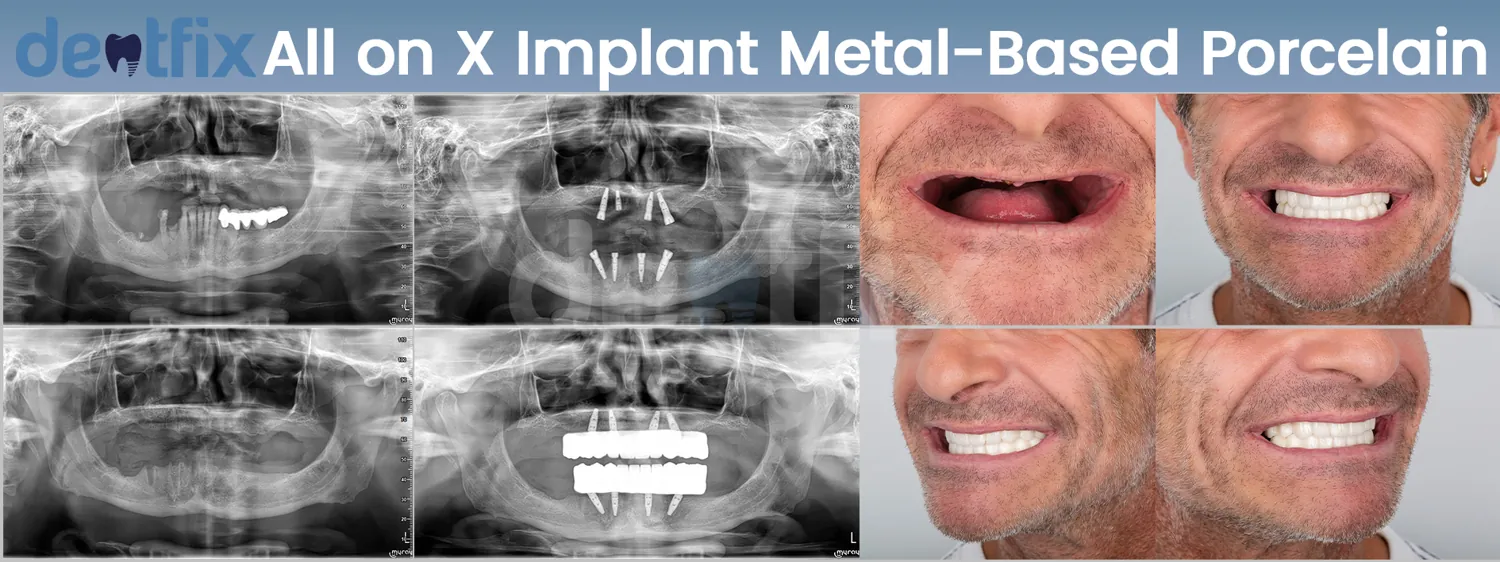 Implants de bouche complète All-on-4 / All-on-6 avant et après — radiographie et sourire, Dentfix Istanbul