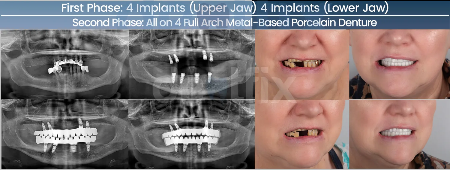Implants de bouche complète All-on-4 / All-on-6 avant et après — radiographie et sourire, Dentfix Istanbul
