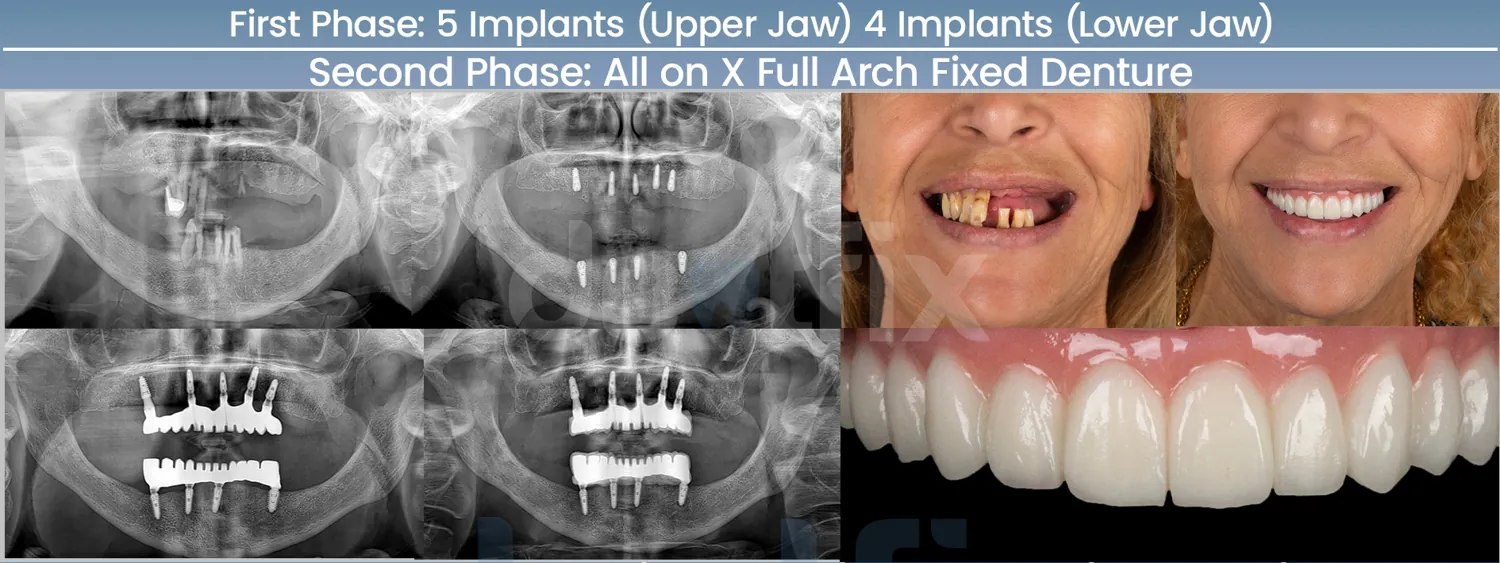 Implants de bouche complète All-on-4 / All-on-6 avant et après — radiographie et sourire, Dentfix Istanbul