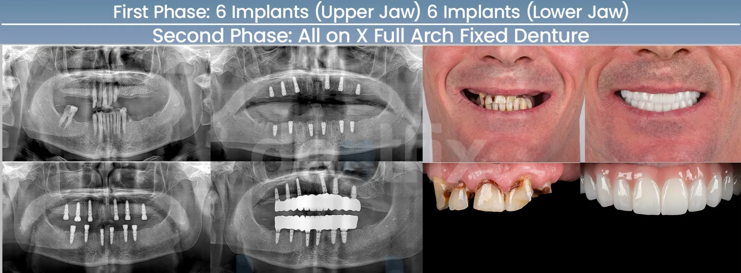Implants de bouche complète All-on-4 / All-on-6 avant et après — radiographie et sourire, Dentfix Istanbul