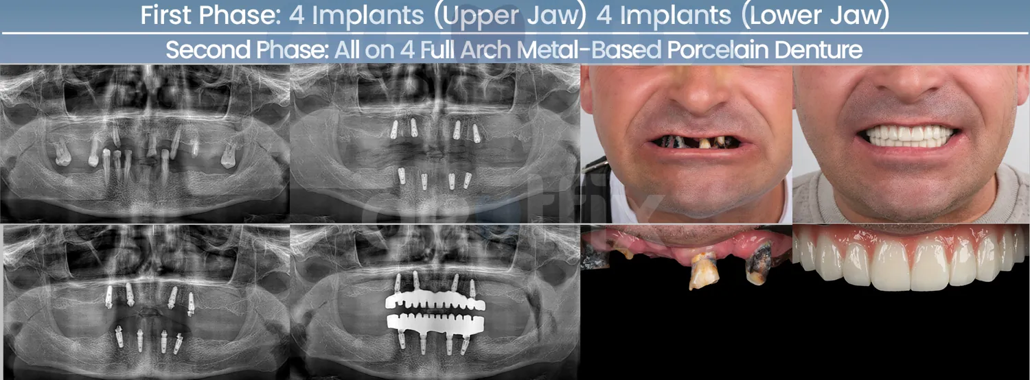 Implants de bouche complète All-on-4 / All-on-6 avant et après — radiographie et sourire, Dentfix Istanbul