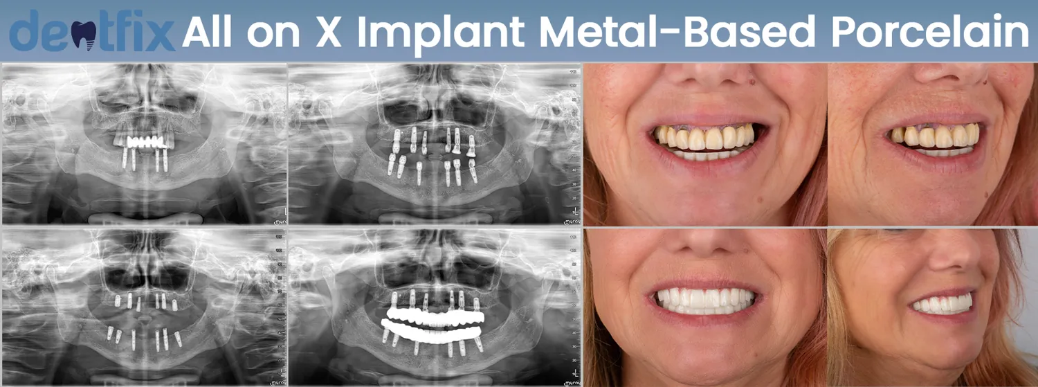 Implants de bouche complète All-on-4 / All-on-6 avant et après — radiographie et sourire, Dentfix Istanbul