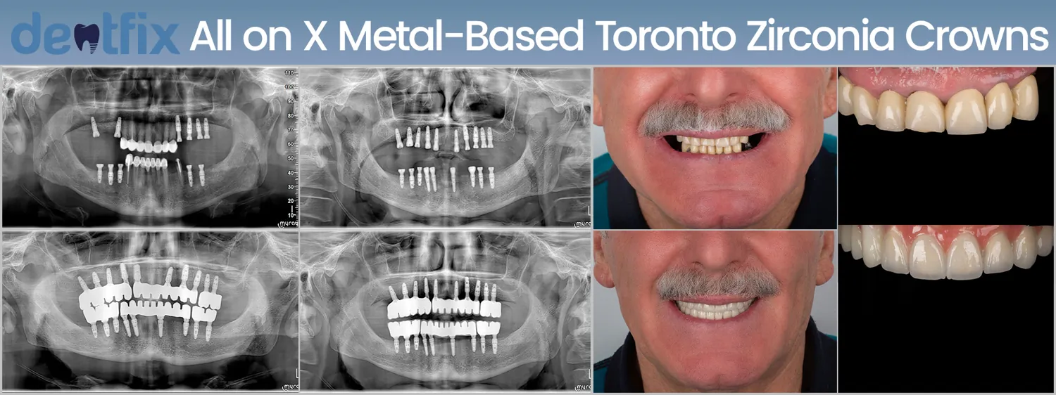 Implants de bouche complète All-on-4 / All-on-6 avant et après — radiographie et sourire, Dentfix Istanbul