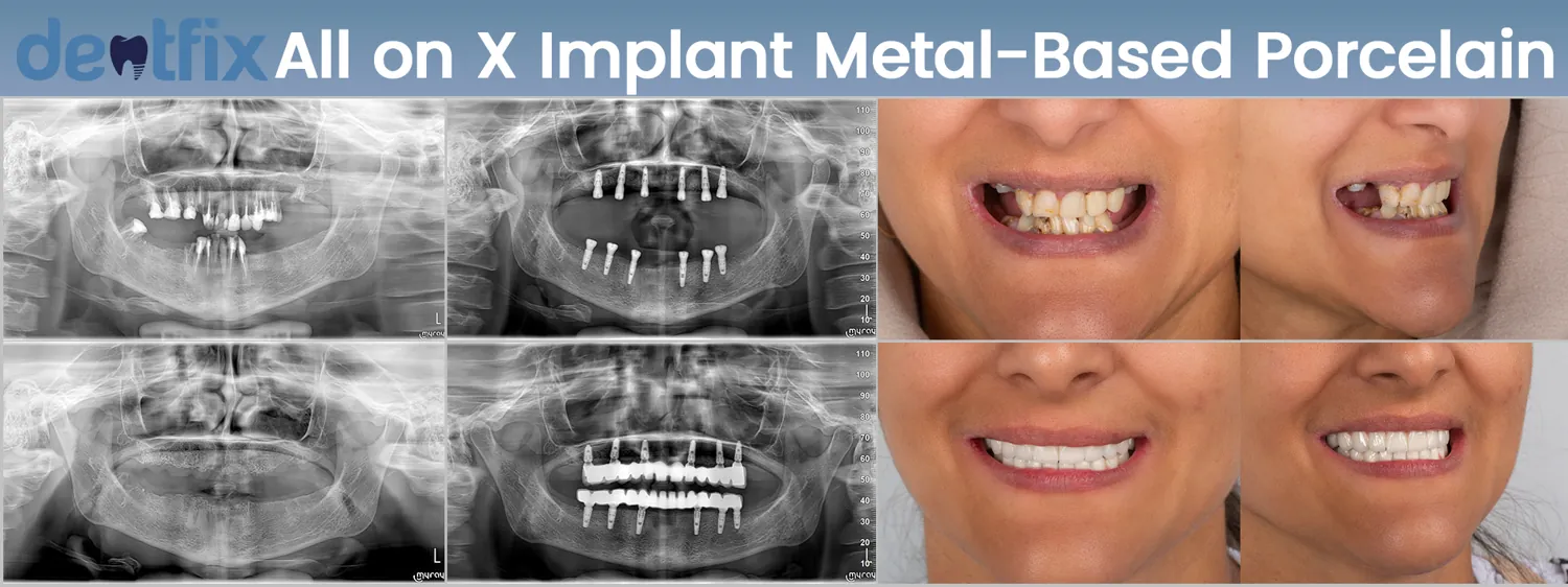 Implants de bouche complète All-on-4 / All-on-6 avant et après — radiographie et sourire, Dentfix Istanbul