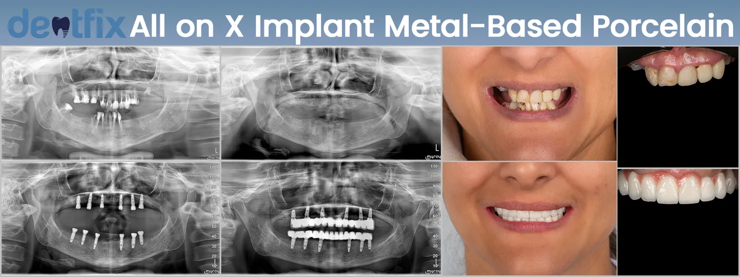 Implants de bouche complète All-on-4 / All-on-6 avant et après — radiographie et sourire, Dentfix Istanbul