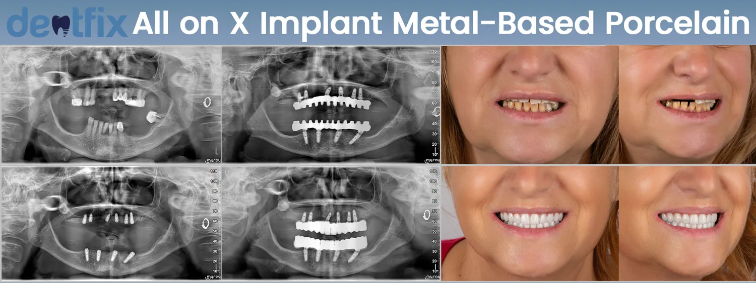 Implants de bouche complète All-on-4 / All-on-6 avant et après — radiographie et sourire, Dentfix Istanbul