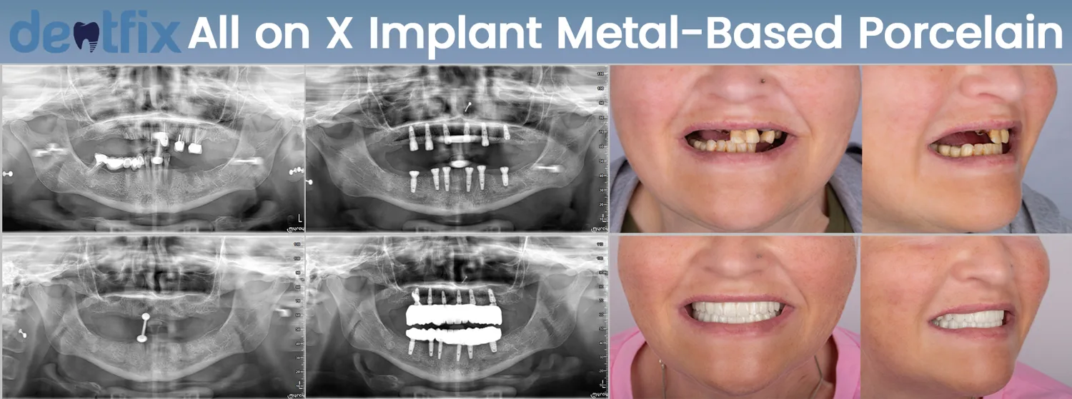 Implants de bouche complète All-on-4 / All-on-6 avant et après — radiographie et sourire, Dentfix Istanbul
