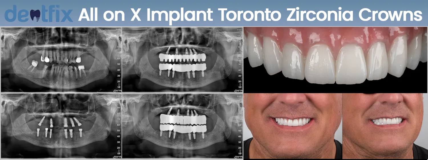 Implants de bouche complète All-on-4 / All-on-6 avant et après — radiographie et sourire, Dentfix Istanbul