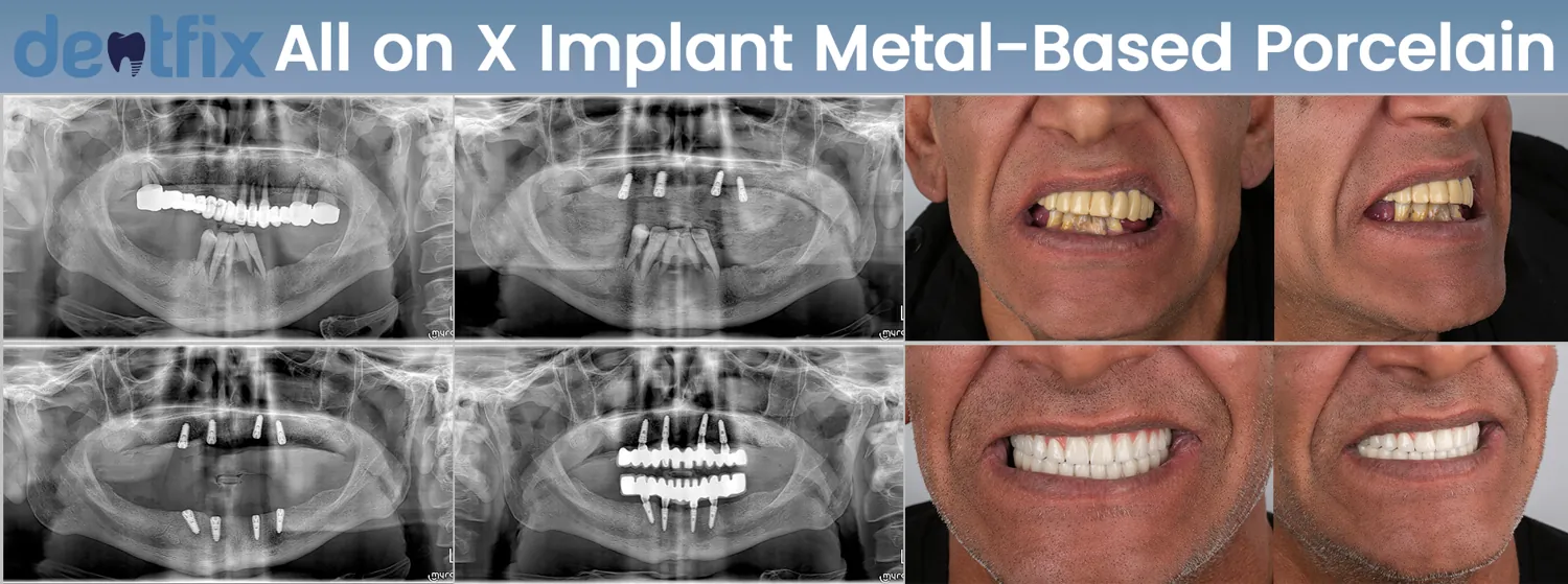 Implants de bouche complète All-on-4 / All-on-6 avant et après — radiographie et sourire, Dentfix Istanbul