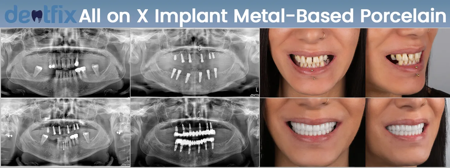 Implants de bouche complète All-on-4 / All-on-6 avant et après — radiographie et sourire, Dentfix Istanbul