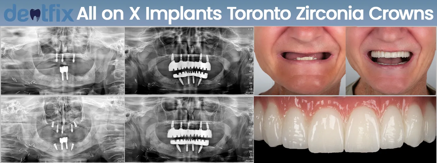 Implants de bouche complète All-on-4 / All-on-6 avant et après — radiographie et sourire, Dentfix Istanbul
