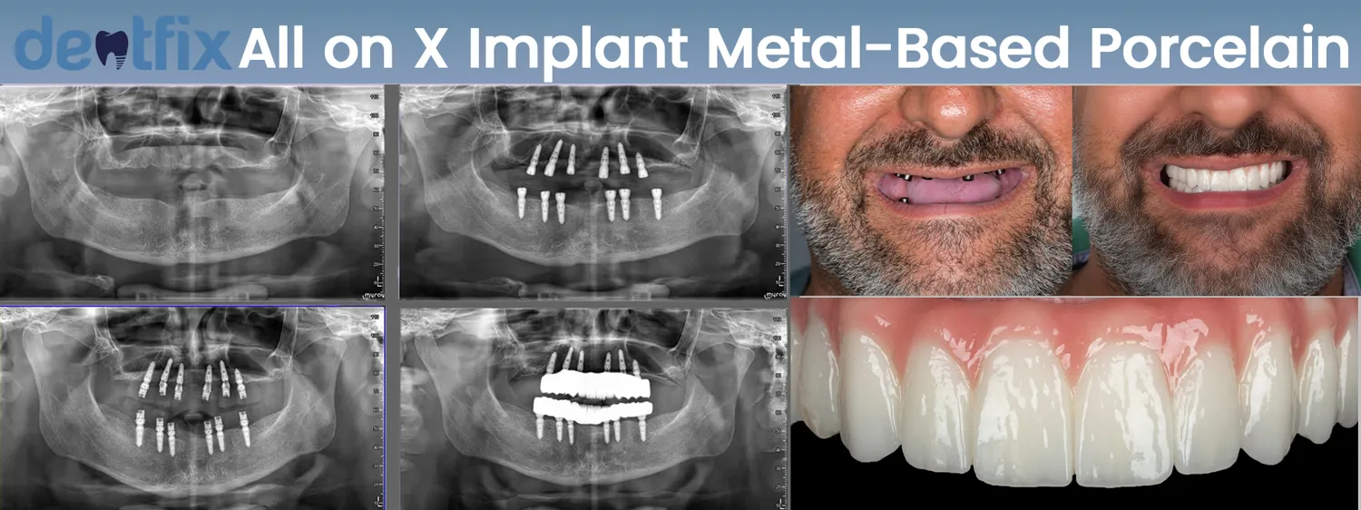 Implants de bouche complète All-on-4 / All-on-6 avant et après — radiographie et sourire, Dentfix Istanbul