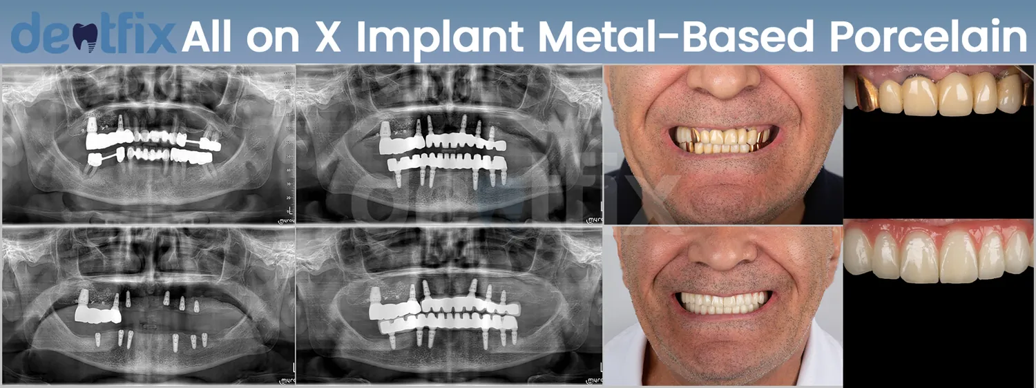 Implants de bouche complète All-on-4 / All-on-6 avant et après — radiographie et sourire, Dentfix Istanbul