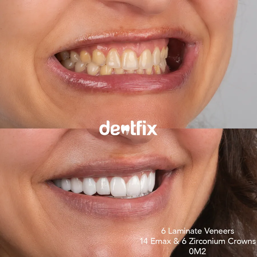 Veneers & E-max