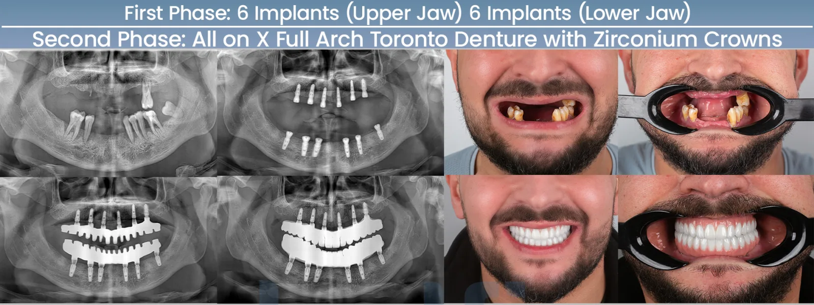 All-on-X implant case with before and after panoramic X-rays — full-arch Toronto bridge at Dentfix Istanbul