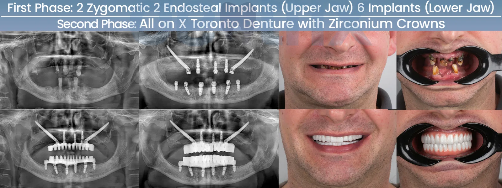 Advanced All-on-X with zygomatic implants — before and after X-rays at Dentfix Istanbul