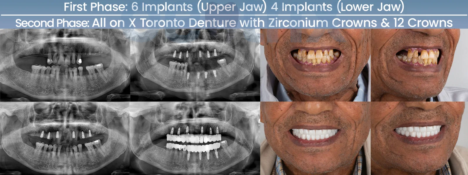 Full-arch All-on-X implant rehabilitation with before and after X-rays at Dentfix Istanbul