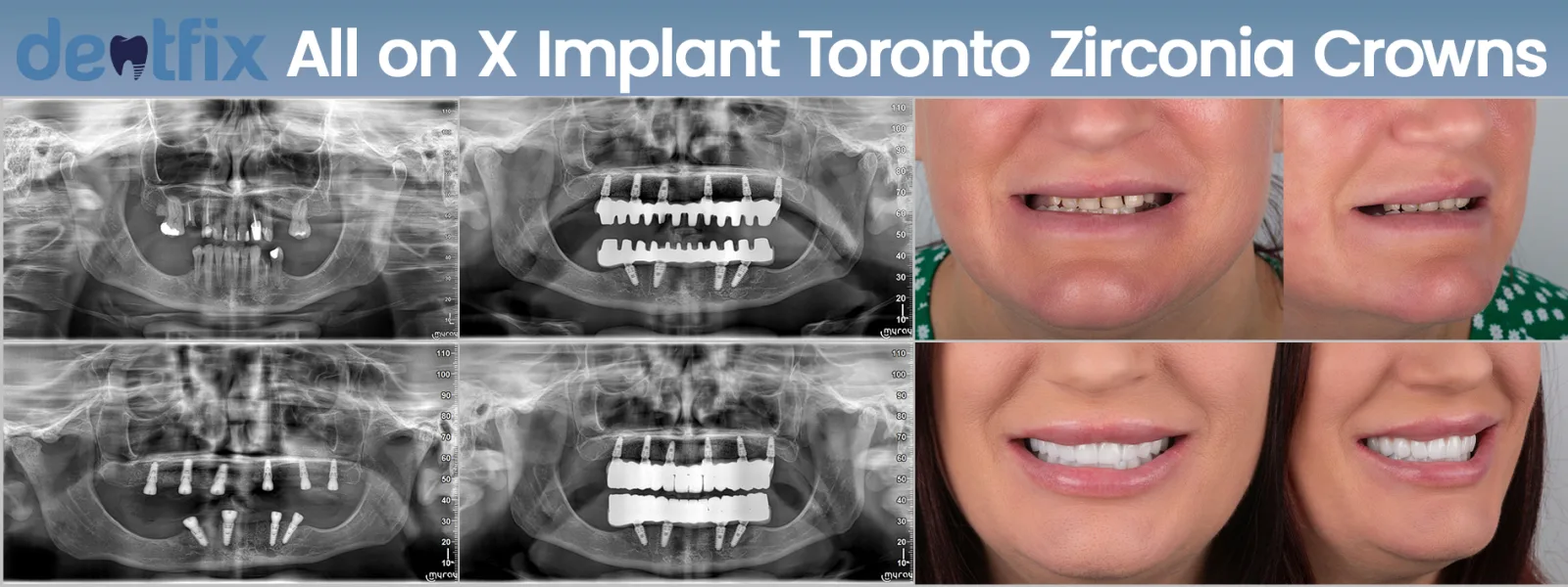 All-on-X fixed full-arch teeth — before and after with panoramic X-rays at Dentfix Istanbul