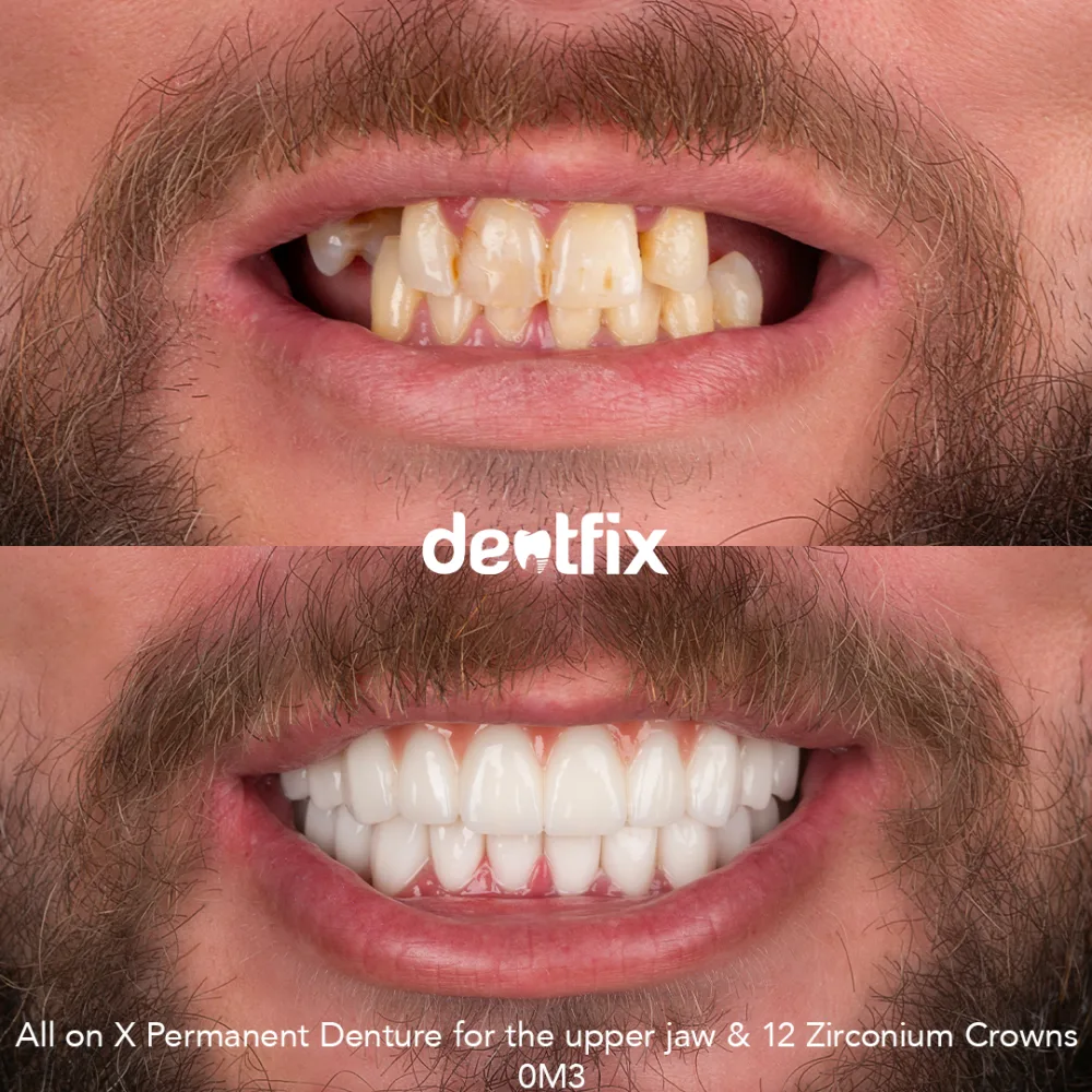Zahnimplantate vorher und nachher — fehlende Zähne ersetzt bei Dentfix Istanbul