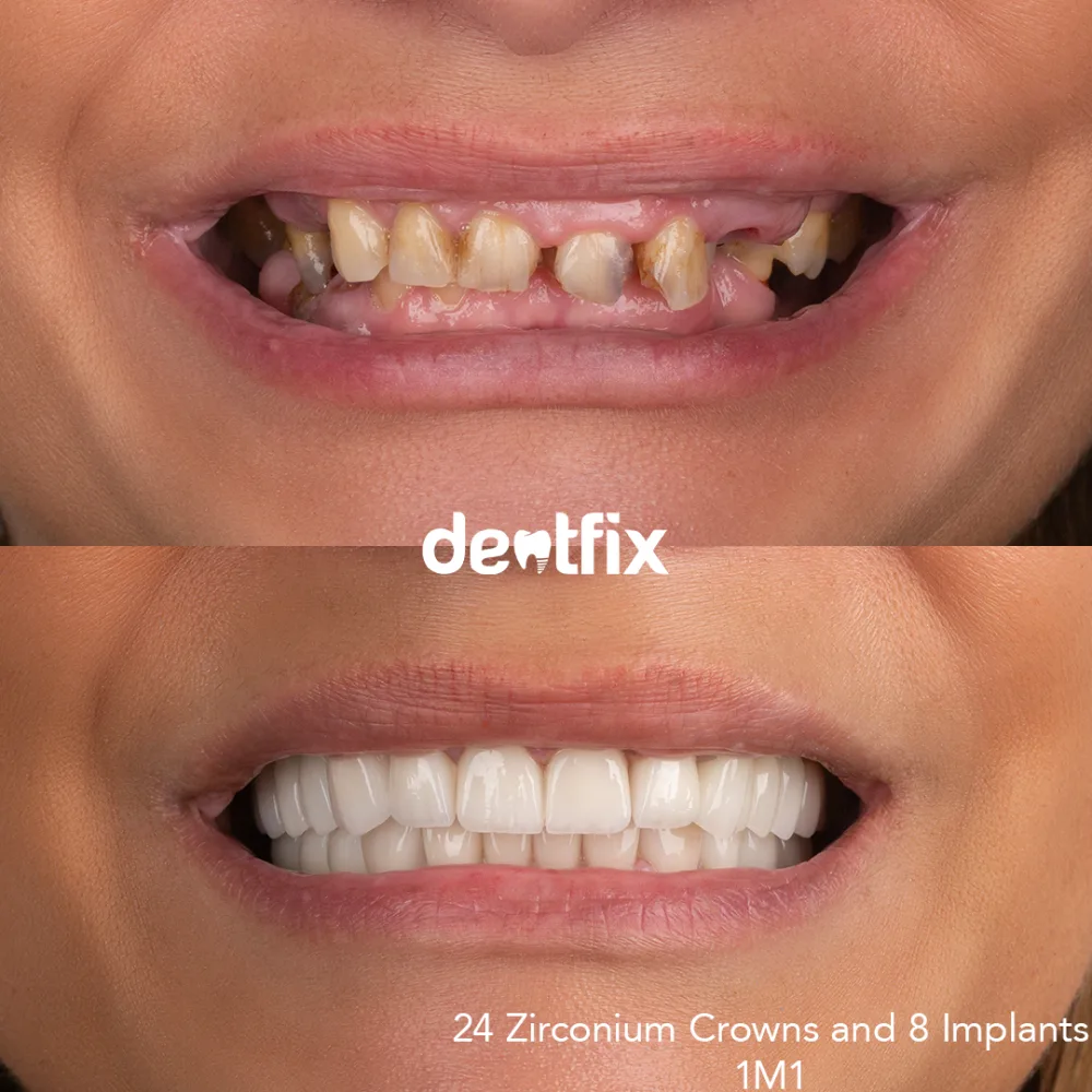 Implantate mit Zirkonkronen vorher und nachher bei Dentfix Istanbul