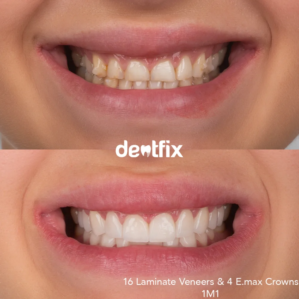 Hollywood smile with E-max veneers before and after at Dentfix Istanbul