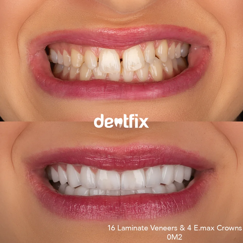 E-max veneers smile makeover — crooked, stained teeth transformed at Dentfix Istanbul