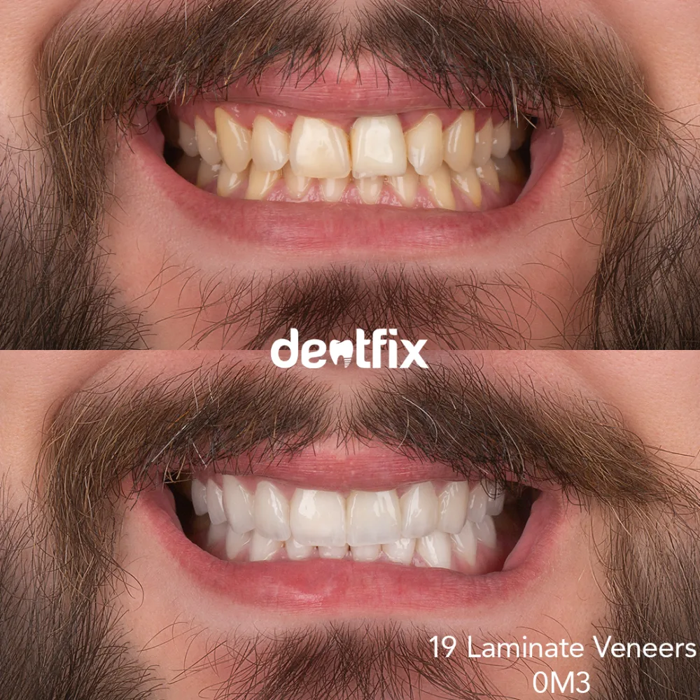 Laminate veneers Hollywood smile before and after at Dentfix Istanbul