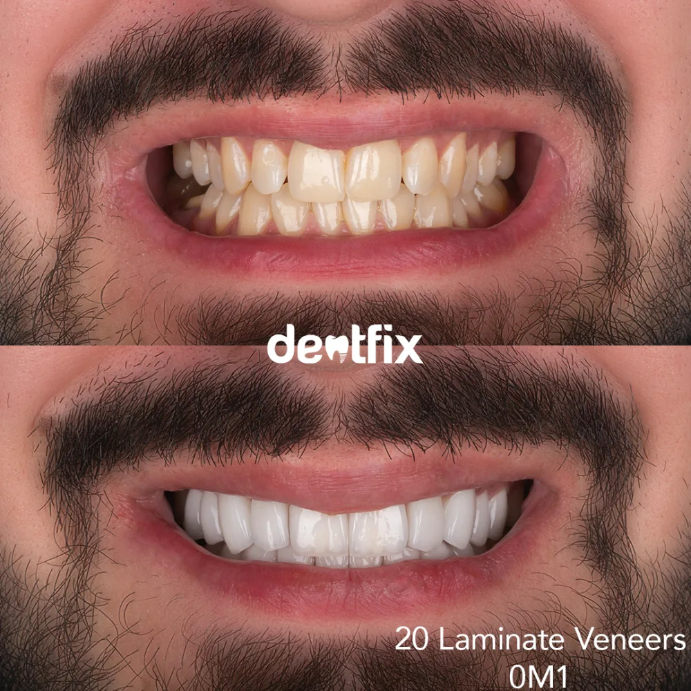 Natural Hollywood smile with laminate veneers at Dentfix Istanbul