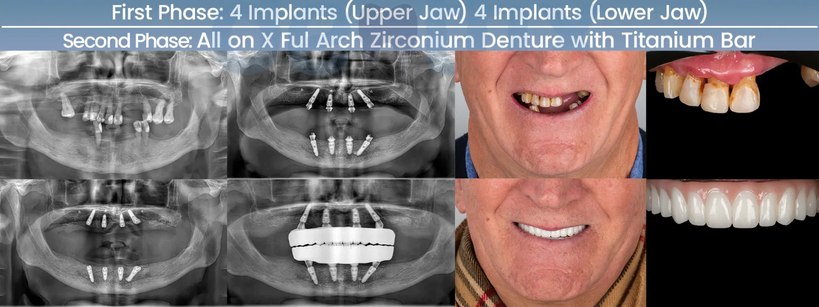 Zahnimplantat-Fall mit Panorama-Röntgenbildern vorher und nachher bei Dentfix Istanbul