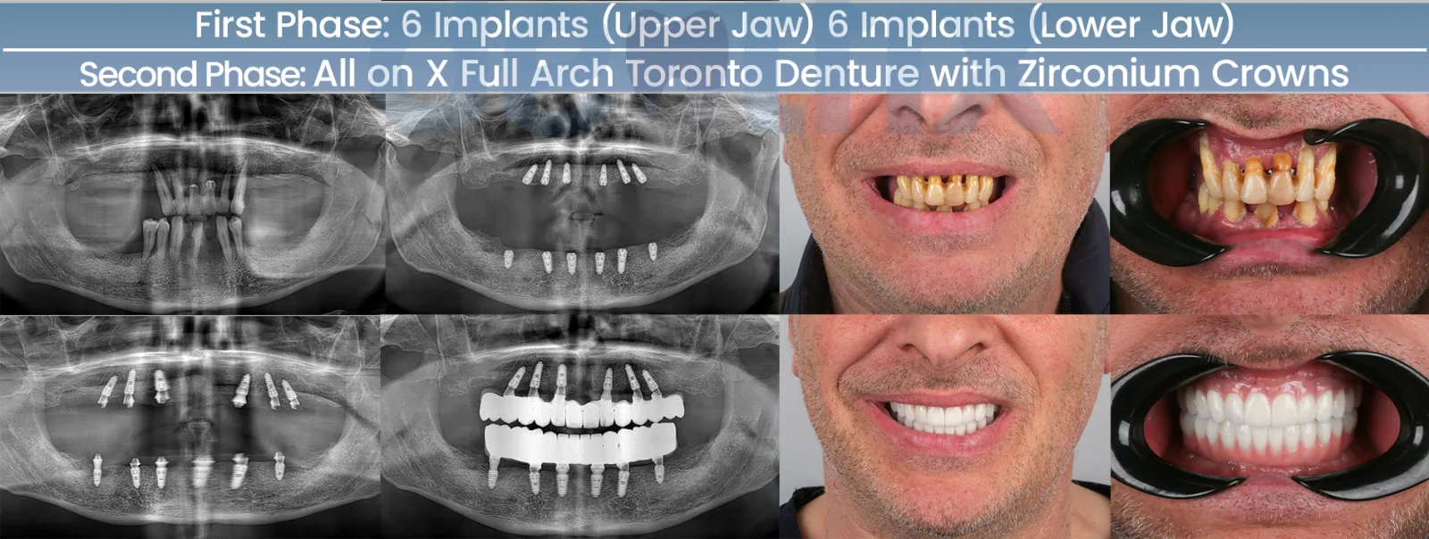 Implantate für den gesamten Kiefer — Röntgenbilder vorher und nachher bei Dentfix Istanbul