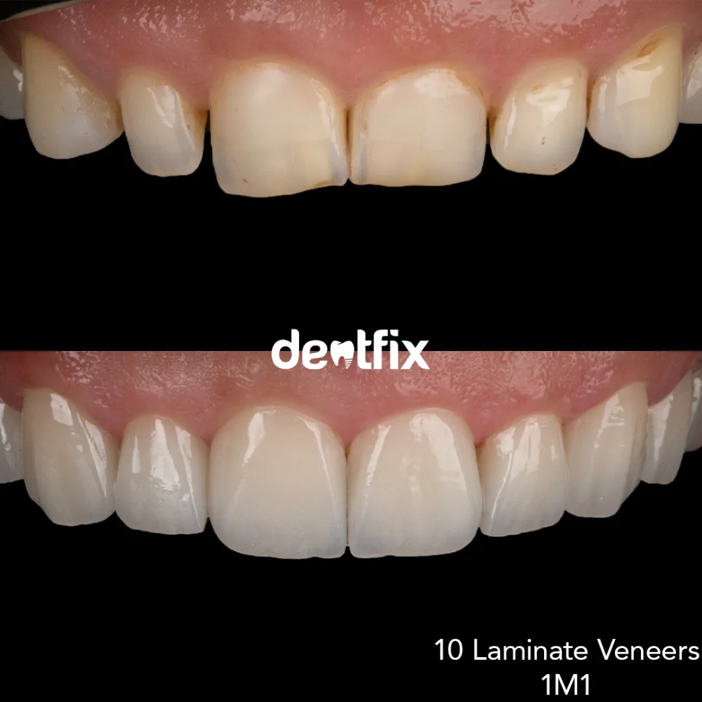 Close-up detail of E-max laminate veneers at Dentfix Istanbul