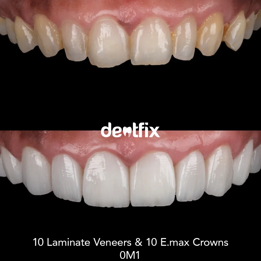 Close-up of a finished Hollywood smile veneer result at Dentfix Istanbul