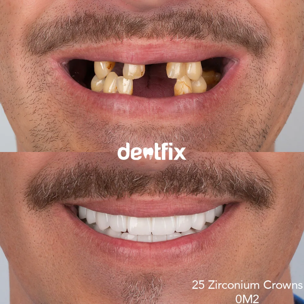 Full-mouth zirconium crowns before and after — missing front teeth fully restored at Dentfix Istanbul