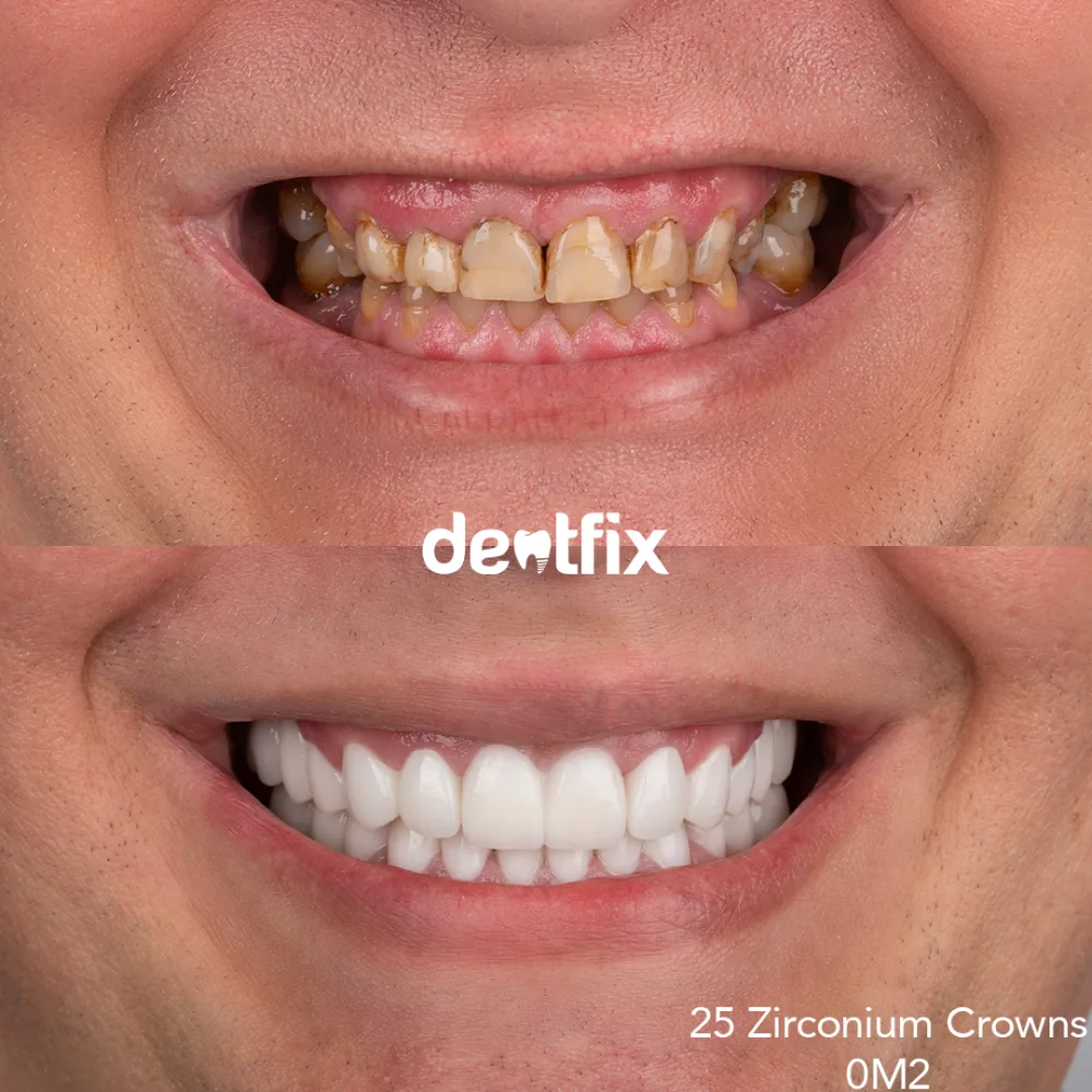 Zirconium crowns before and after — worn, decayed teeth rebuilt at Dentfix Istanbul