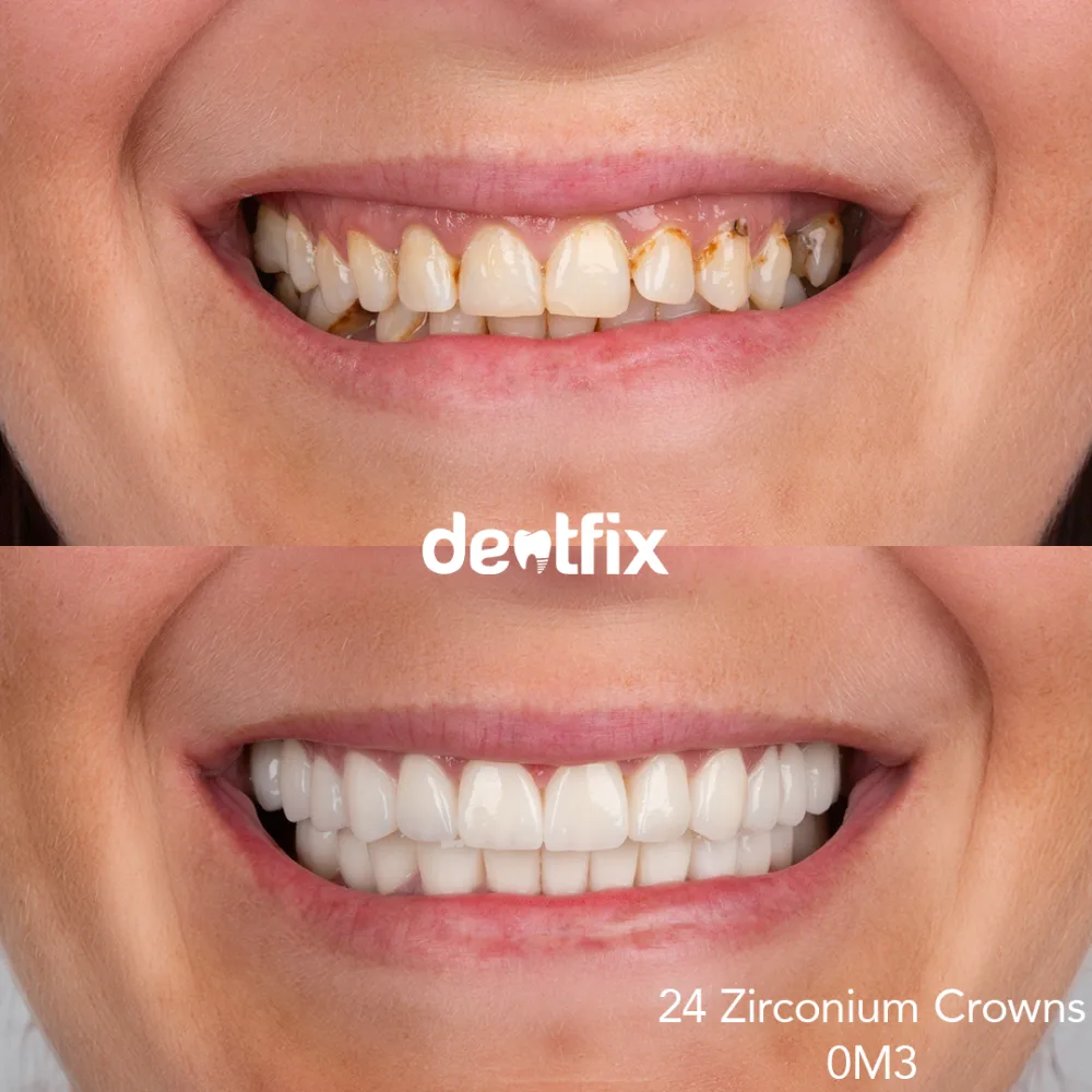Full-mouth zirconium crown smile makeover at Dentfix Istanbul