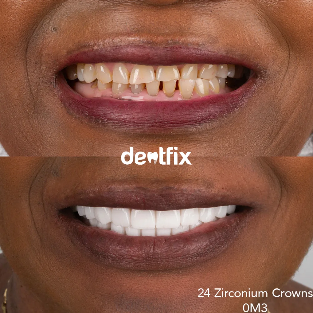 Zirconium crowns before and after — crooked, stained teeth transformed at Dentfix Istanbul