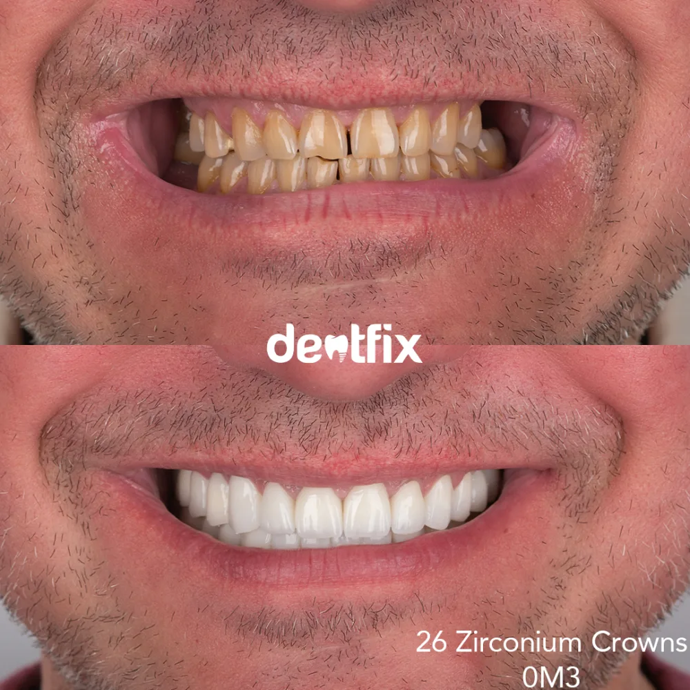 Natural-looking full-mouth zirconium crowns at Dentfix Istanbul