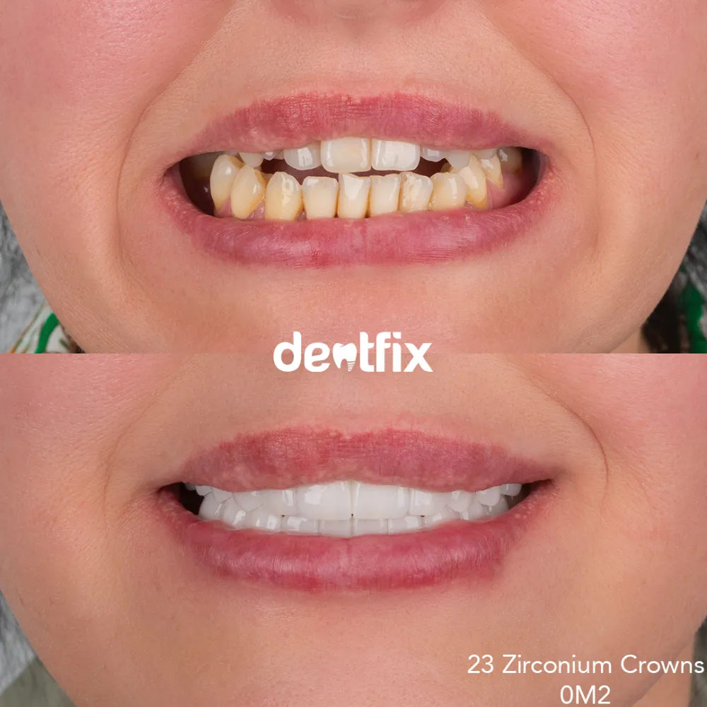 Full smile reconstruction with zirconium crowns at Dentfix Istanbul