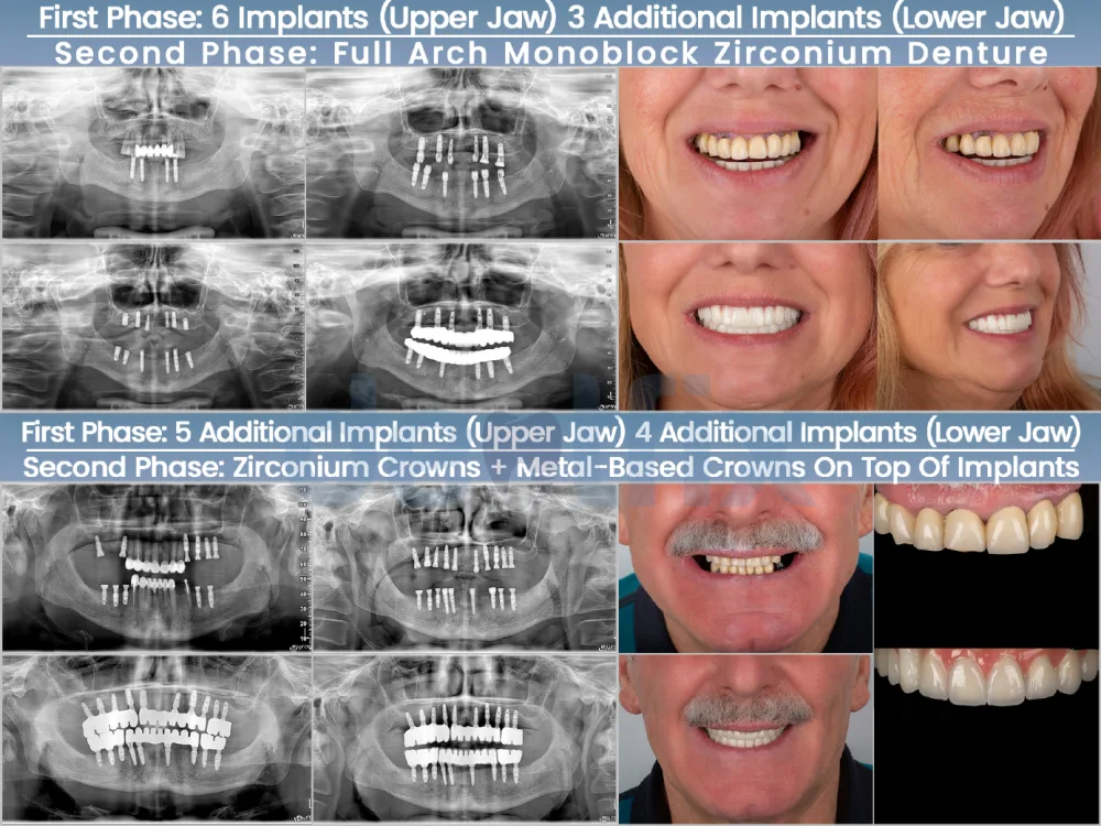 Zygomatic implants — fixed teeth for severe upper-jaw bone loss