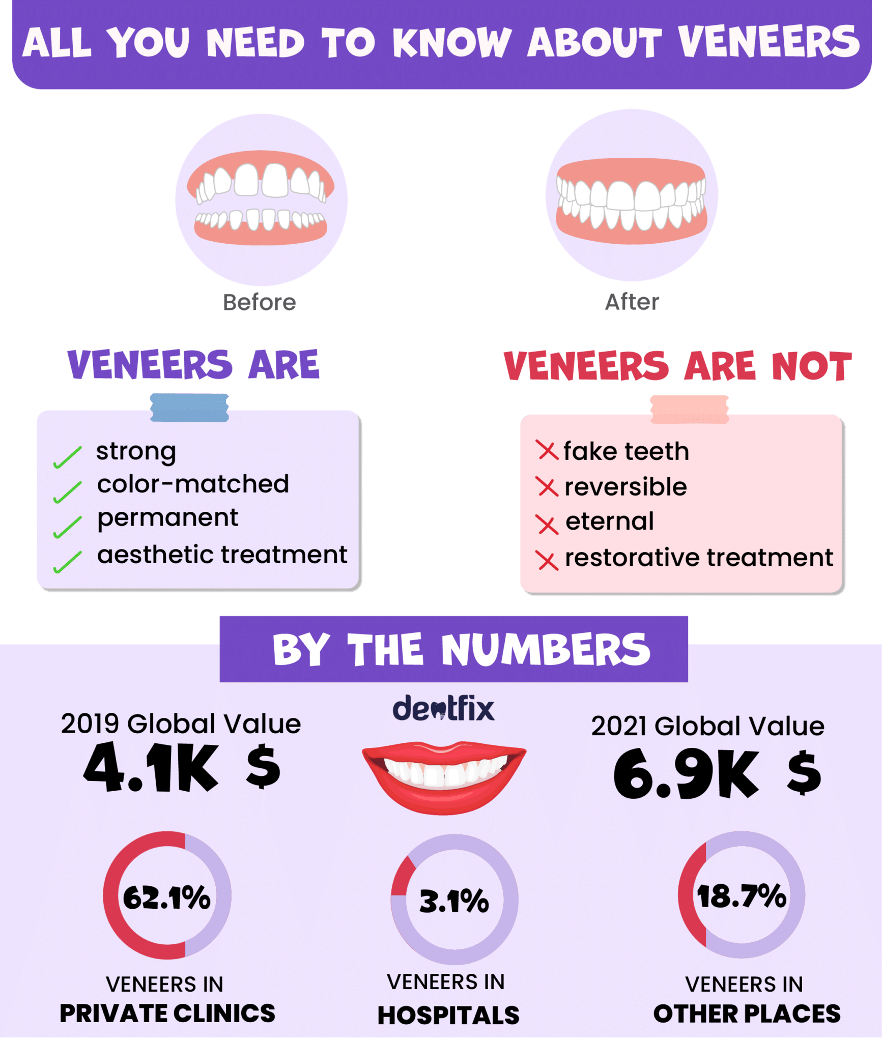 what are veneers