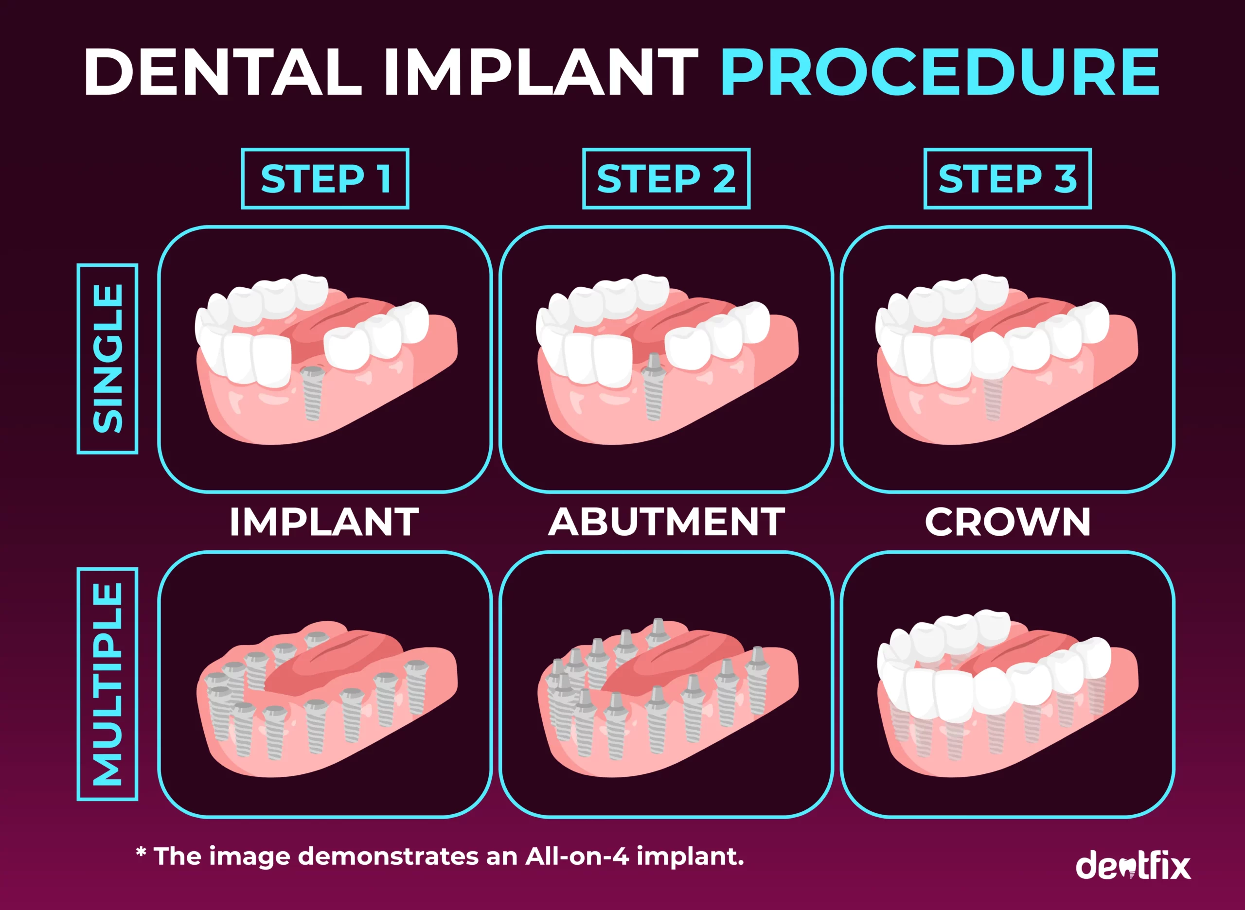 dental implant procedure