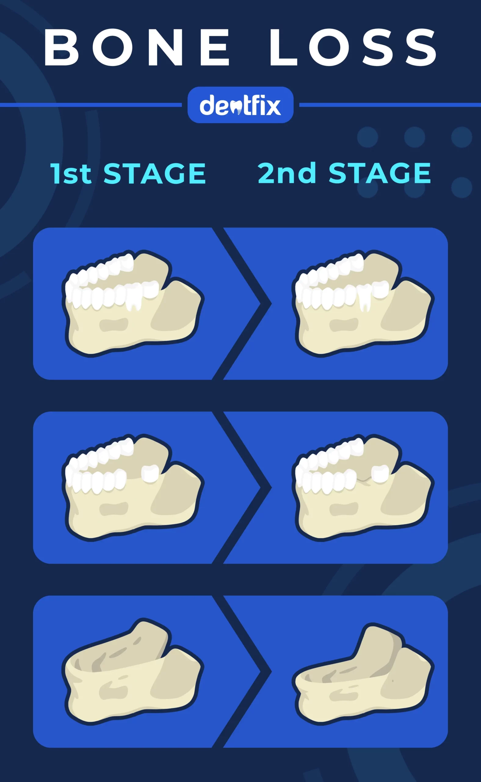 bone loss in teeth