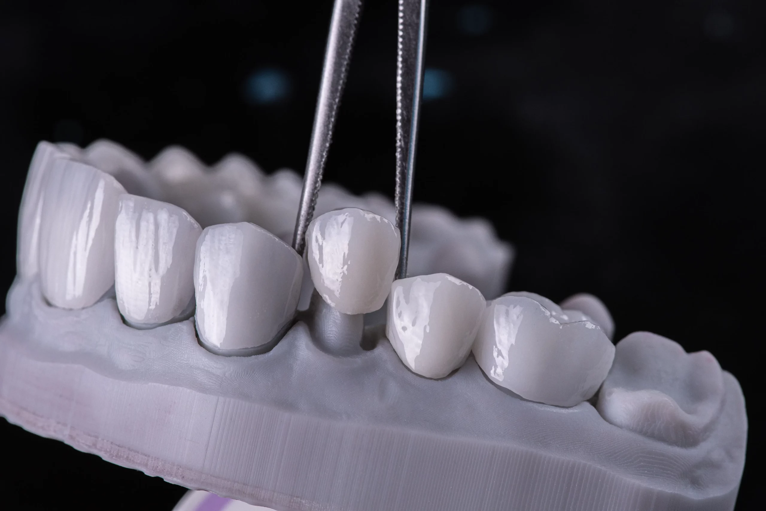 dental crowns from a lab