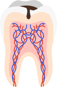 dental cavity on top
