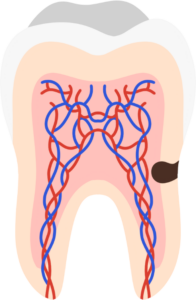 dental cavity on root