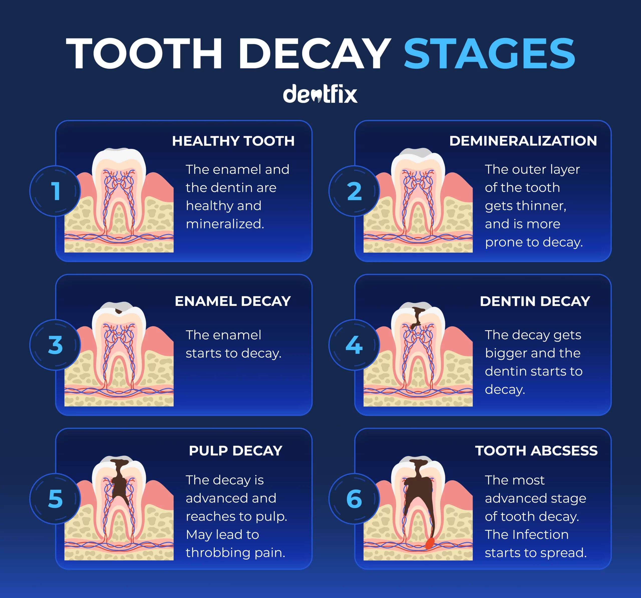 tooth decay stages