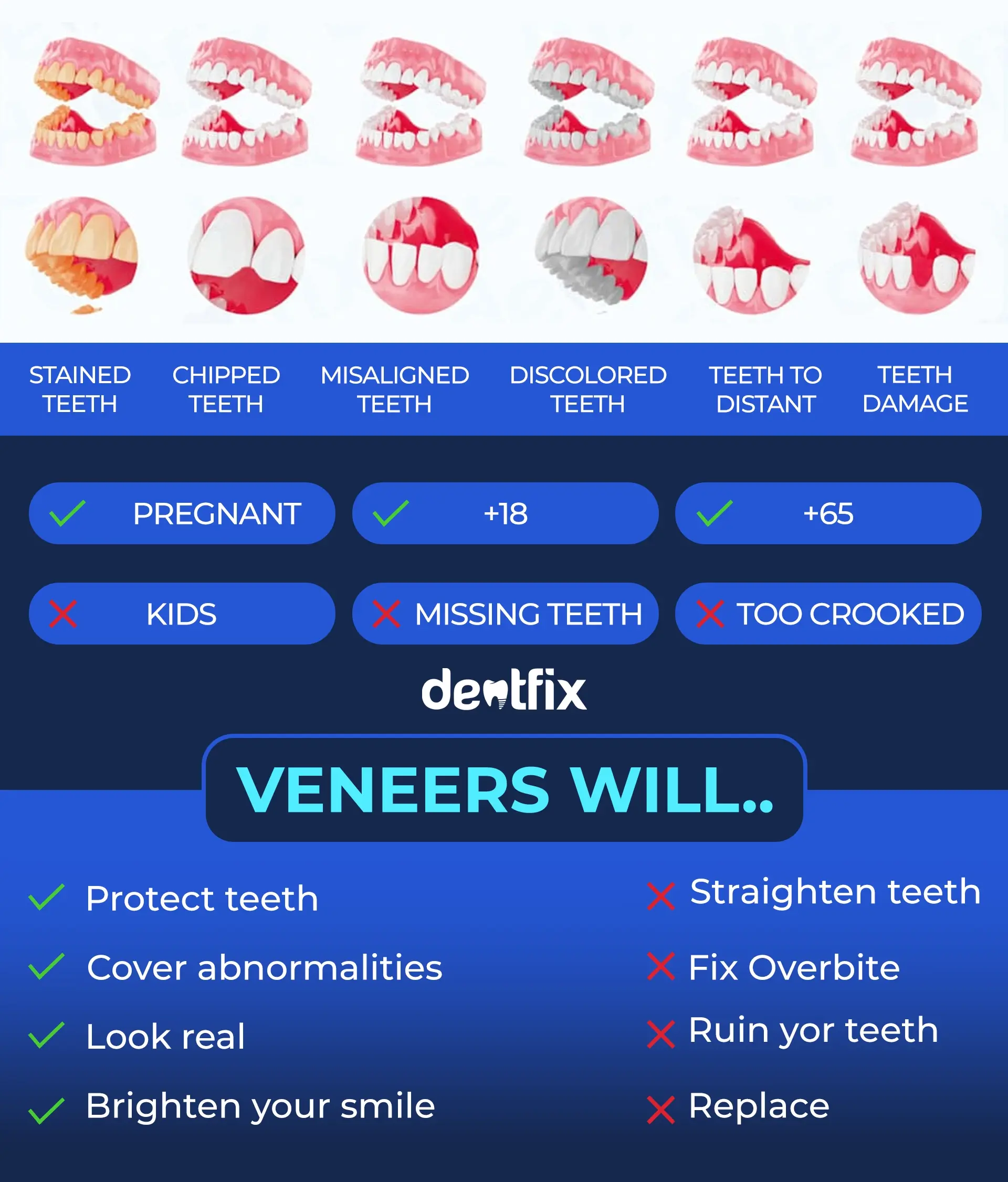 Dental veneers pros and cons